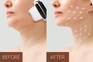 BJ-1957 Multifunctional Ultrasonic Skin Scrubber before&after